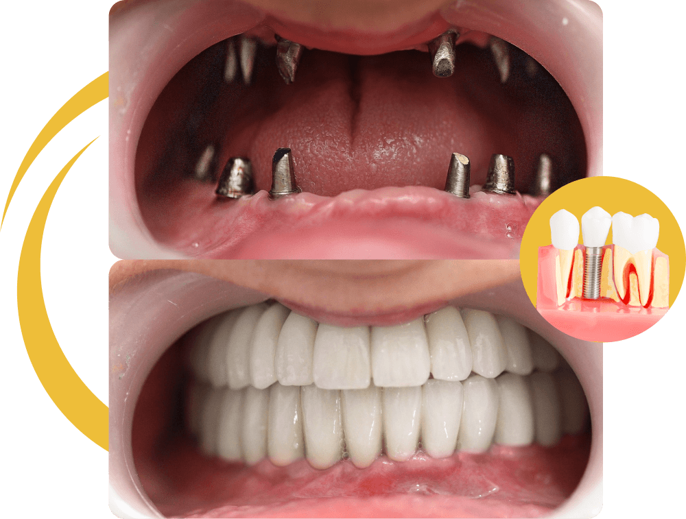 Dental Implants Turkey Dental Implants Before & After